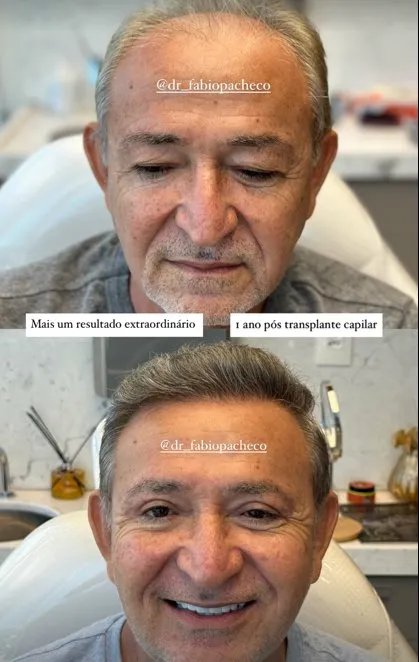 1 ano pós transplante