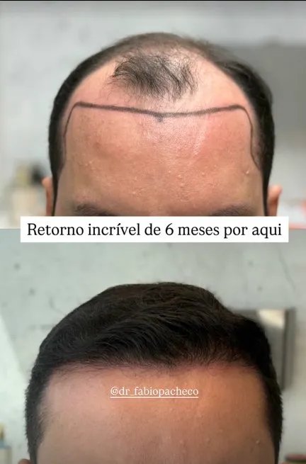 6 meses pós transplante