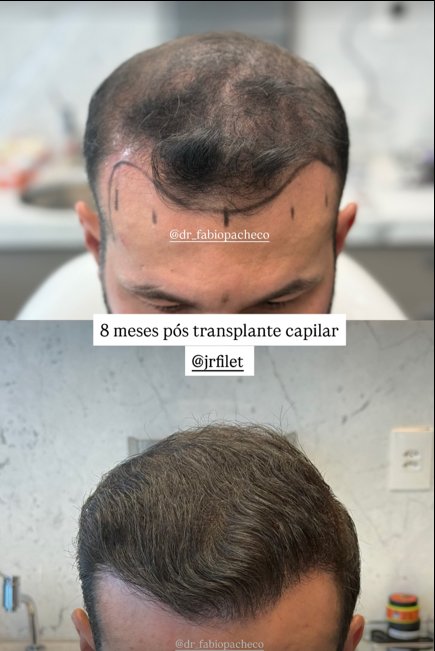 8 meses pós transplante